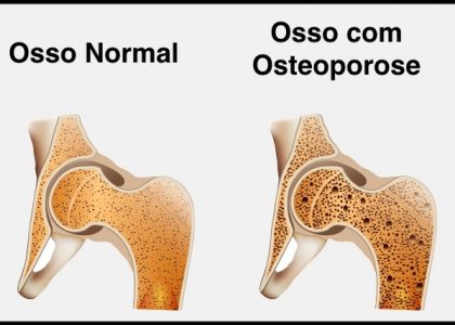 osteoporose